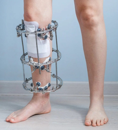 аппарат илизарова, чрескостный остеосинтез, удлинение конечностей, ЦИТО, РНЦ ВТО, кронштейн