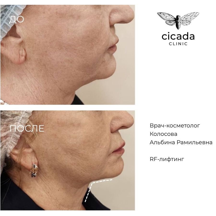 Микроигольчатый RF-лифтинг - результат Сicada Clinic