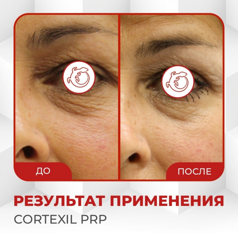 cortexil prp до и после