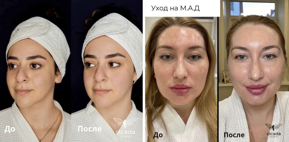 Уход на дерматокосмецевтике M.A.D в Cicada Clinic