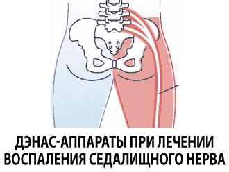 ДЭНАС-аппараты при лечении воспаления седалищного нерва