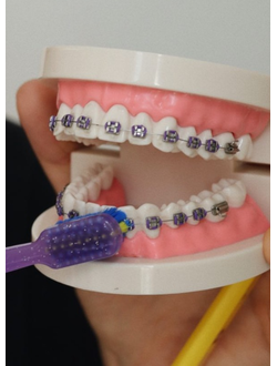 ОРТОДОНТИЯ (Брекеты)