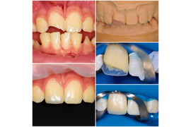 Травма зуба