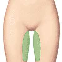 Внутренняя поверхность бедер. Аппарат ДЭНАС ПКМ | НЕЙРОДЭНС ПКМ. 