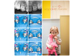 Лечение молочных зубов